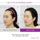 차 앤 박 헤어 | 모앤라인│여성 M자이마 자연스러운 헤어라인 모발이식 5개월차 경과 후기💕(ㅁㅇㄹㅇ)