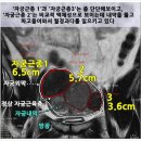 야탑경희한의원 | 48세 내막침범 출혈성 자궁근종의 자연한방치료