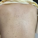 큰사랑 한의원 | 편평사마귀 성지 자연재생한의원! 강남 편평사마귀 제거 후기