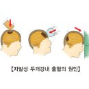 외상에 의한 뇌 손상[Traumatic brain injury] 이미지