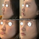 3749 | Ep.3 | 복코+매부리+기능코 (비염) 무보형물 코수술 후 한달 후기 + 실비 환급