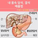 내 몸속 담석, 결석 배출법 이미지