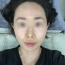 서울피부과 | 수원광교 기미치료 10회차 내돈내산 완료 후기<서울나온피부과>