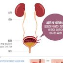 방광염 피덩어리 혈뇨 원인 일상 관리법 총정리 이미지