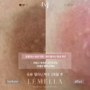 오늘도빛나다 | 원주 유륜미백 1회만에 가능하다고 ? 르멜라 후기 많은 곳 오늘도빛나다
