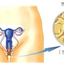 질 칸디다증(Vaginal Candidiasis)이란? 이미지