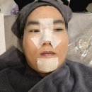 필 | 피부과 가성비 모공 시술! 블랙헤드 화이트헤드 피지관리 아쿠아필 후기