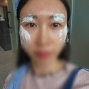 눈꺼풀필러/눈밑꺼짐필러 내돈내산 리터치 후기