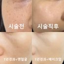 압구정 라움성형외과 주근깨 레이저 1년 경과 후기 (비용, 예약 꿀팁)