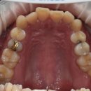 수면 사랑니 발치 한번에 4개 IV sedation 가능한가 ? 깊은 매복사랑니 예시 후기를 통한 비용 가격