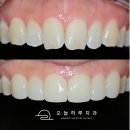 미소치과기공소 | 장지동 라미네이트 치과, 최소삭제로 자연스럽게 개선한 실제 사례
