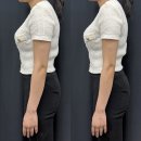 천안 복부 지방분해주사 뱃살 빼는 법 에스핏 다이어트 후기 전후 비교