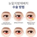닥터홍이비인후과의원 | 신사 홍닥터의원 눈밑지방재배치 후기 (1주차 + 1달차 변화까지)