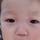 이상곤 | 17개월아기 눈물샘 막힘 시술후기