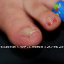 손톱나라네일아트 디자인연구소의 일일수업-파고드는 발톱에 대한 세미나~ 이미지