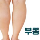 다리 붓기 빼기 다리부종 원인 대처법 이미지