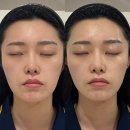 피부관리콜 | 수영피부관리 에스테인 이중턱리프팅 케어 후기