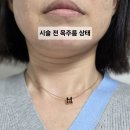 성화약국 | &lt;강남역피부과 리뽀주사 ( 지방추출주사 ) + 이중턱근육묶기 베러미의원 후기&gt;
