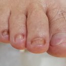 나도손톱 레푸스 개봉점 이미지