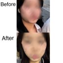 풀페이스의원 | 광주 인모드 풀페이스 시술 후기 멍, 회복기간, 1주일 변화까지