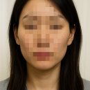 호리병라인 | 땅콩형 얼굴 30대 중반 후반 여자 민트 실리프팅 쥬베룩 볼륨 팔자주름없애기 볼패임 6개월 후기