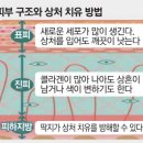 Viva 유도 | 비바덤의원, 레이저 시술 후 딱지가 생길까요?[궁금해요 닥터VIVA]
