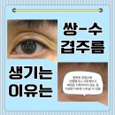 겹쌍꺼풀, 쌍꺼풀재수술잘하는병원 찾는 방법 알려드려요 이미지