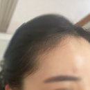 광주 일곡동 :: 헤어라인 왁싱 후기 [드오브왁싱&amp;뷰티] 전/후 사진 공개