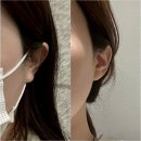 강남역성형외과에서 귀필러맞고 누운귀가 요정귀 된 후기