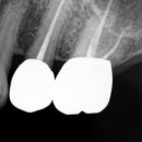 엔도코어 이미지