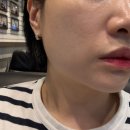 얼굴홍조치료 붉은기 없애기 프락셀레이저후기