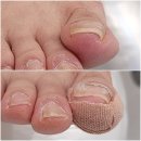 한소리 | 천안내성발톱 전문적인 발관리 후기 레푸스 천안두정점