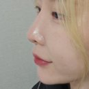 압구정역피부과 입술필러 붓기 일주일차 후기 쥬브겔
