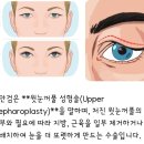 퀸즈성형외과의원 | ​[마곡 성형외과] 코코아이성형외과 상안검 상담 받고 왔어요~! 쌍수, 눈지방제거