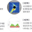 눈 녹내장 초기 증상 치료 완치 얼마나 될까? 검사 이미지