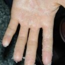 여자들의 고통, 예쁜 손 망치는 피부질환 3가지 이미지