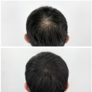 늘채움뷰티 : 남성정수리탈모 두피커버(목동 SMP, 목동 두피문신, 양천구 두피문신, 양천구 SMP, 가격공개)