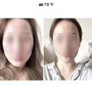 말턱고개 | 턱보톡스 + 윤곽주사 후기