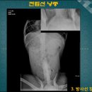 전립선낭종(한수동물병원퍼옴) 이미지