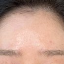 여름의원 | 강남역 피부관리 유명한곳 여름의원 모공 포텐자 후기, 가격