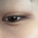 아그네스 | 한관종 제거 아그네스 내돈내산 후기(2회차)