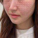 소공지하쇼핑센터 | 을지로피부과 명동 리쥬란 2cc 내돈내산 후기｜통증·효과·다운타임 총정리