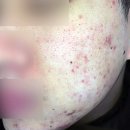 조피부과의원 | 범계 홍 조 여드름 피부과 케어 방법은?