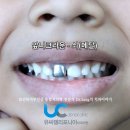 길음만물 | 앞니크라운 가격 두개 치료 후기, 치아크라운종류 차이 움짤 비교