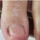 네일크루 | 일산 대화동 발톱무좀 두꺼워지고 노란 발톱 관리 받은 후기 페디크루일산서구점 네일은 young