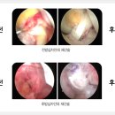 무릎병원에서 알려 드리는 전방십자인대파열 및 무릎수술 이미지