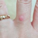 드라이아이스 | 손가락 티눈 셀프 제거 후기 민간요법 식초 드라이아이스로 해결 없애기 완결