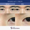 정진빌딩(지지빌딩) | 앞트임재수술, 같은 고민이 반복되지 않으려면