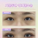 서울자연의원 | 서울동안의원 비절개쌍꺼풀(매몰/자연유착) 2개월차 후기, 짝눈 개선과 화려한 라인 완성