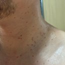 나하나빌딩 | 강남역 편평사마귀치료 내돈내산 후기 (+1달 후 후기)